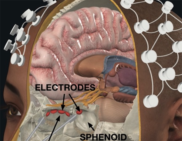 Illustrated image of deep brain